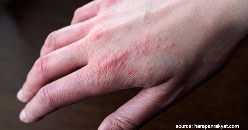 jenis Alergi pada Kulit - eksim dermatitis atopik