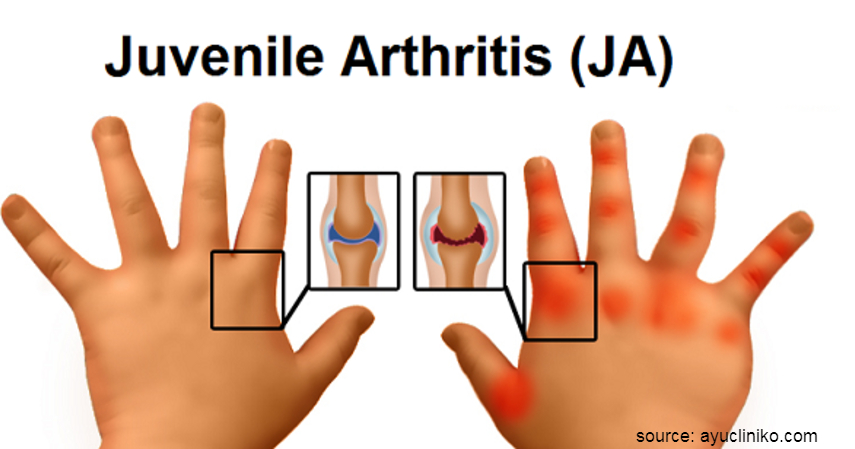 Jenis-jenis Peradangan Sendi - Juvenile Rheumatoid Arthritis