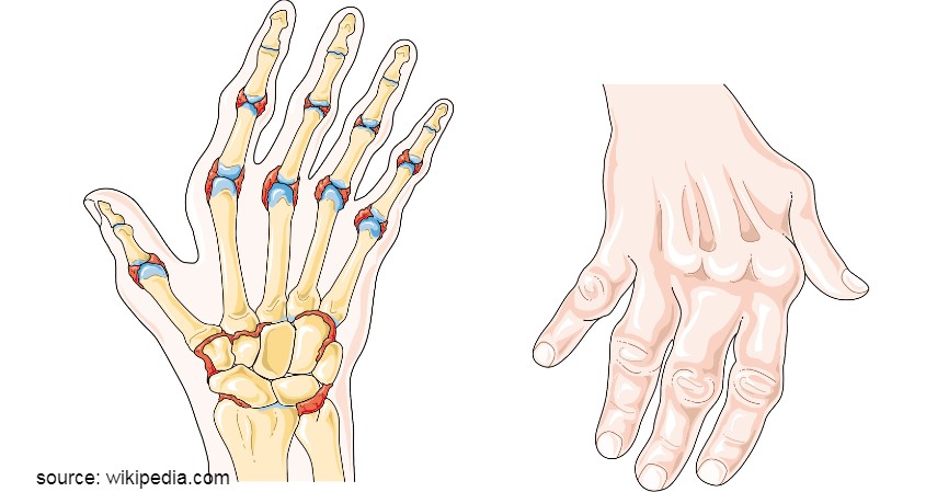 Jenis-jenis Peradangan Sendi - Rheumatoid Arthritis