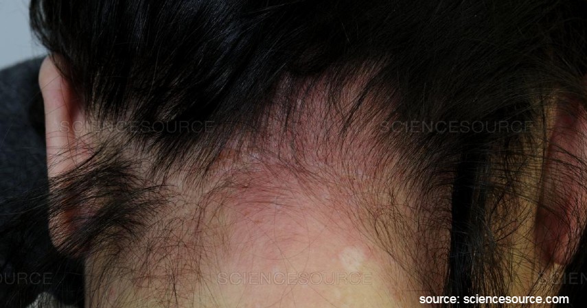 Menyebabkan alergi - Dampak Negatif Mewarnai Rambut