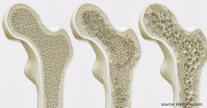 Mencegah osteoporosis - Manfaat Susu Kambing Etawa